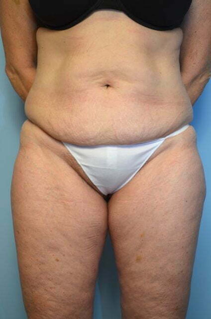Liposuction Before & After Gallery - Patient 187283 - Image 1