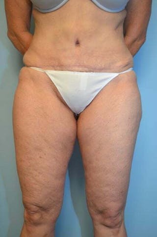 Umbilical Float Tummy Tuck Before & After Gallery - Patient 313151 - Image 2