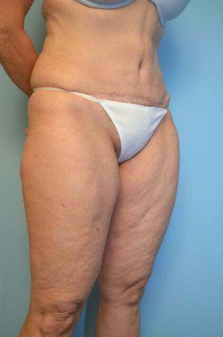 Umbilical Float Tummy Tuck Before & After Gallery - Patient 313151 - Image 4
