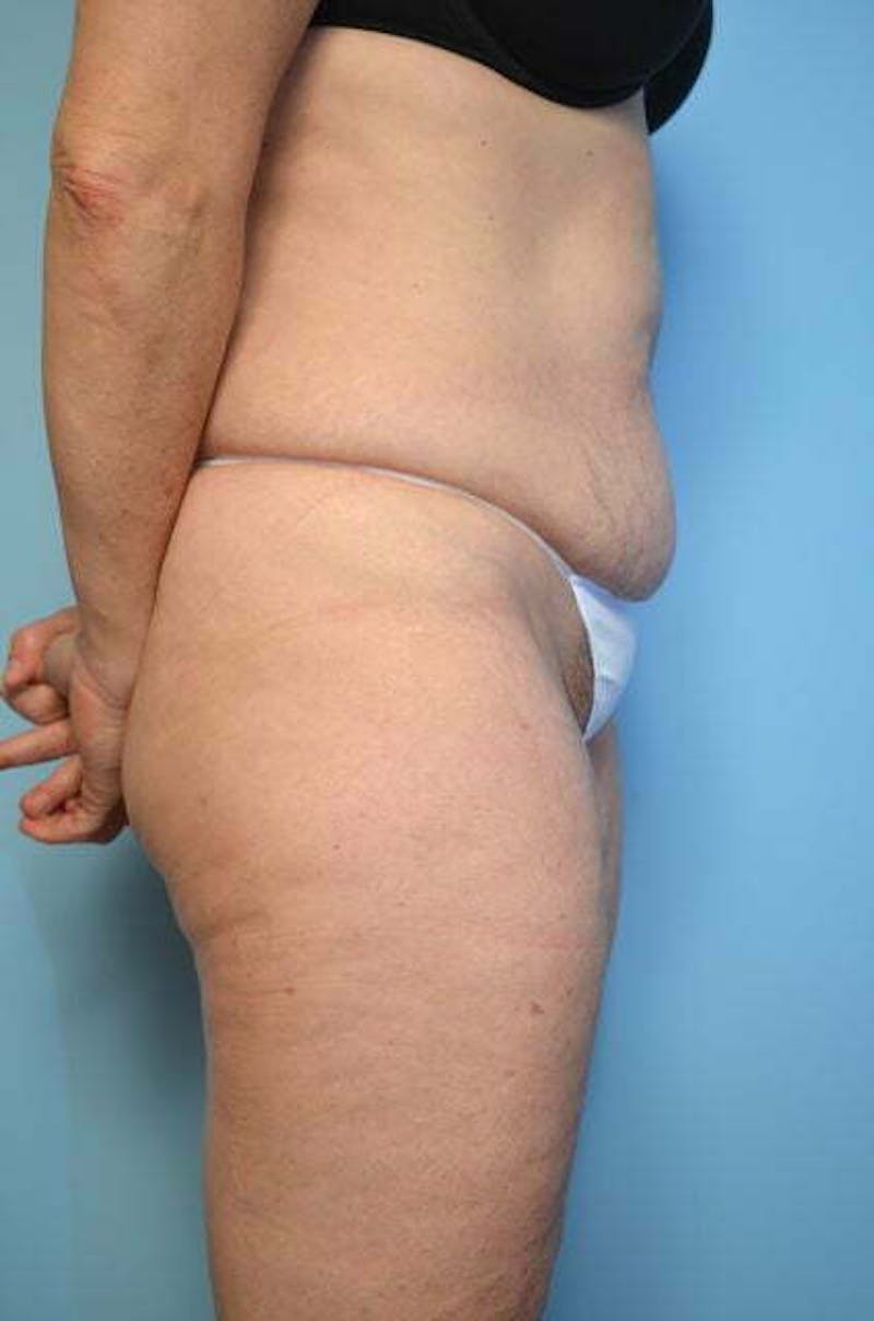 Liposuction Before & After Gallery - Patient 187283 - Image 5