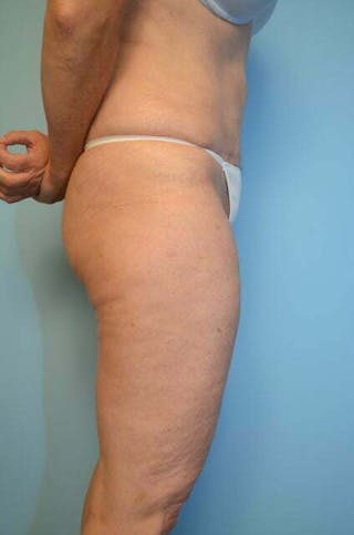 Umbilical Float Tummy Tuck Before & After Gallery - Patient 313151 - Image 6