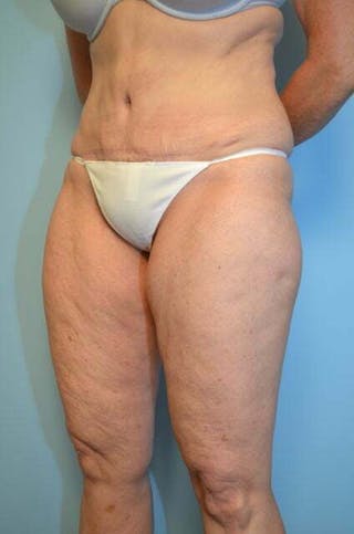 Umbilical Float Tummy Tuck Before & After Gallery - Patient 313151 - Image 8