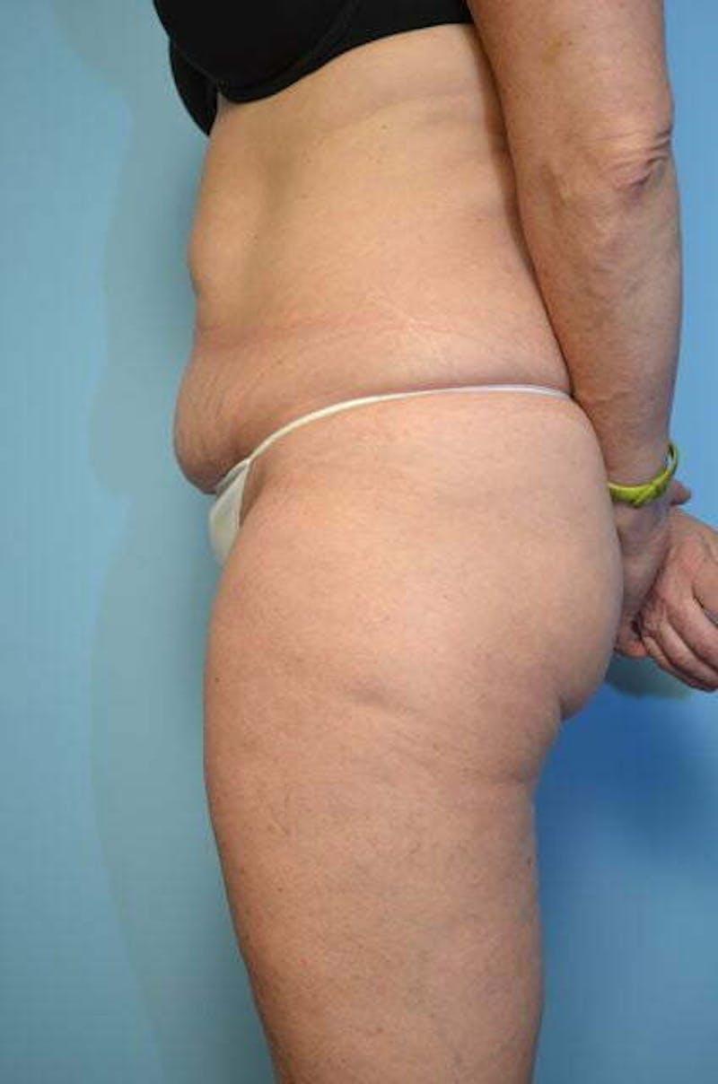 Liposuction Before & After Gallery - Patient 187283 - Image 9