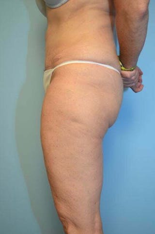 Umbilical Float Tummy Tuck Before & After Gallery - Patient 313151 - Image 10