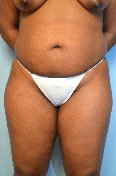 Liposuction Before & After Gallery - Patient 645895 - Image 1