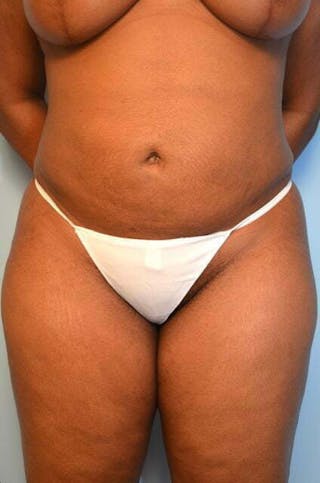 Liposuction Before & After Gallery - Patient 645895 - Image 2