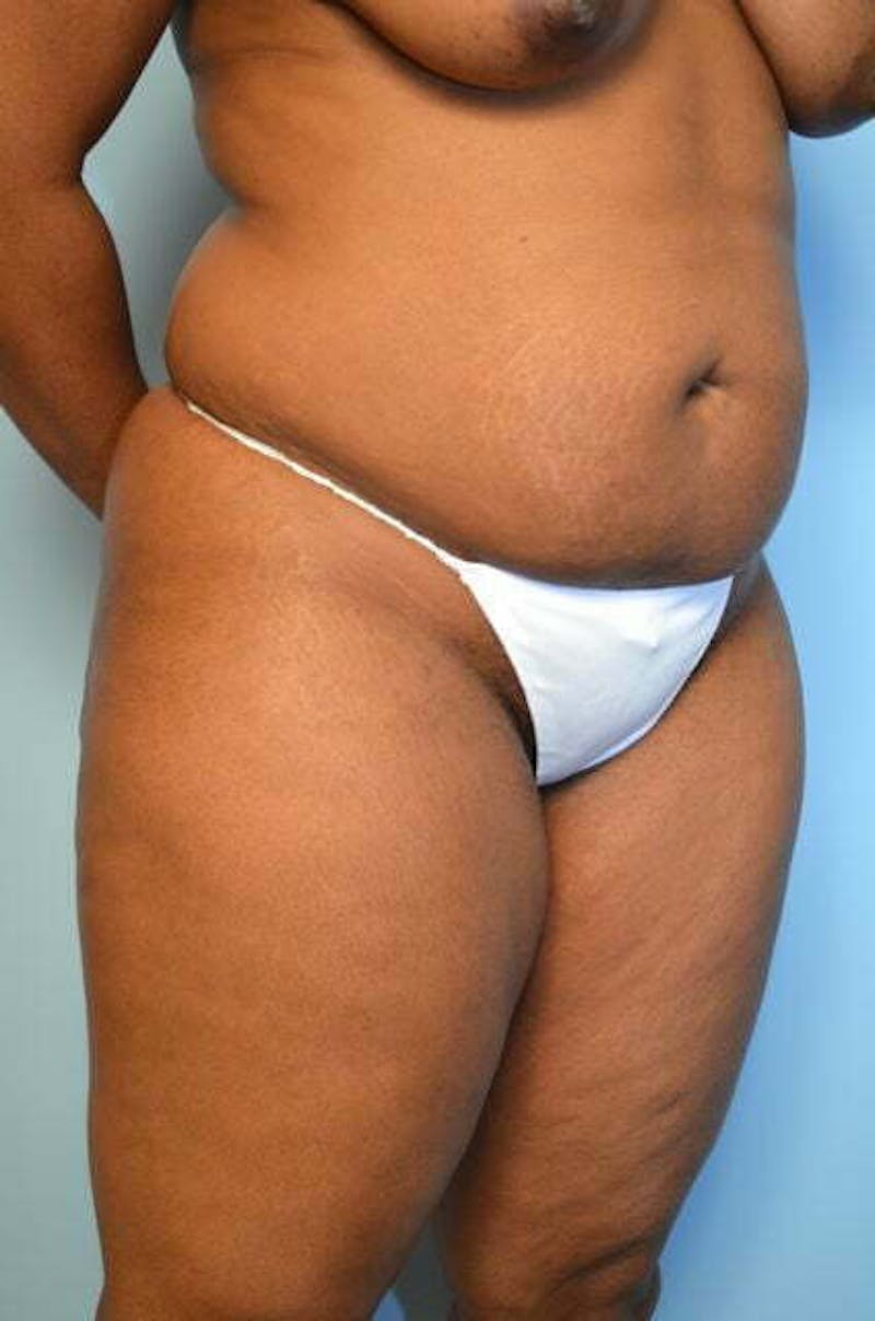 Liposuction Before & After Gallery - Patient 645895 - Image 3