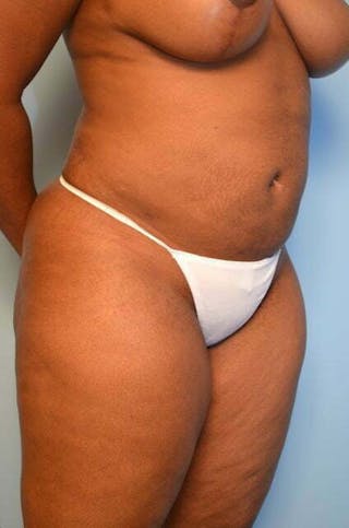 Liposuction Before & After Gallery - Patient 645895 - Image 4