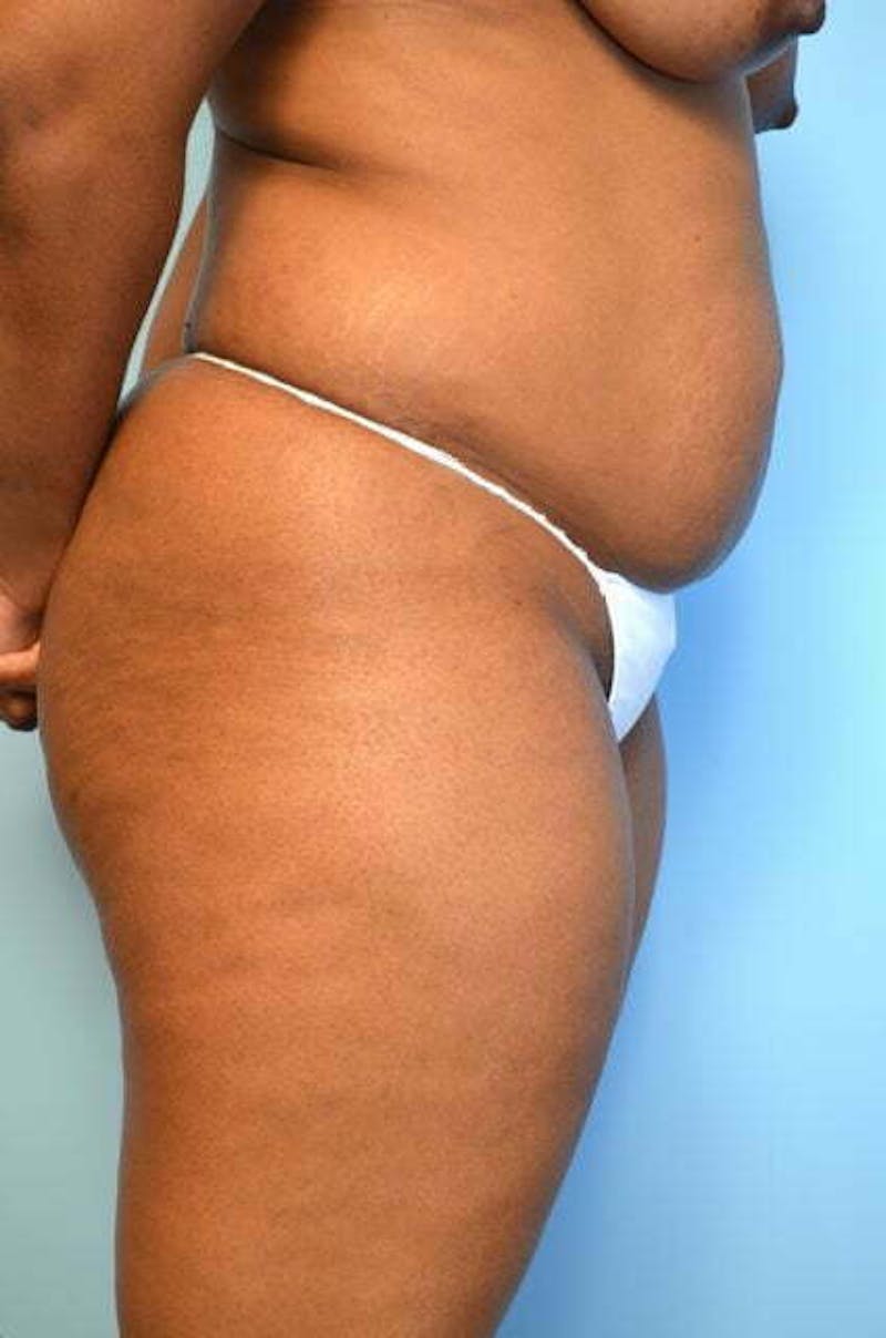 Liposuction Before & After Gallery - Patient 645895 - Image 5