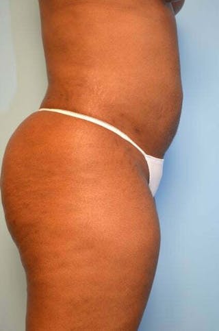 Liposuction Before & After Gallery - Patient 645895 - Image 6
