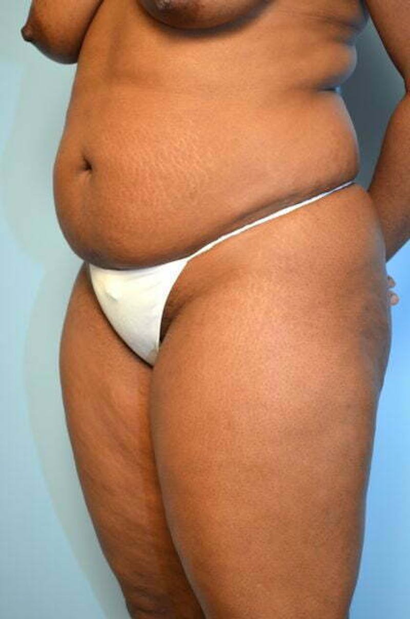 Liposuction Before & After Gallery - Patient 645895 - Image 7