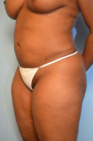 Liposuction Before & After Gallery - Patient 645895 - Image 8