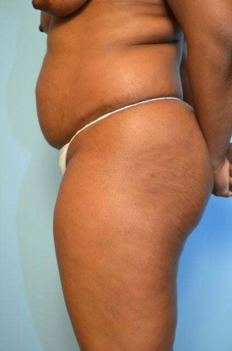 Liposuction Before & After Gallery - Patient 645895 - Image 9