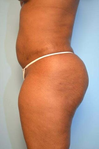 Liposuction Before & After Gallery - Patient 645895 - Image 10