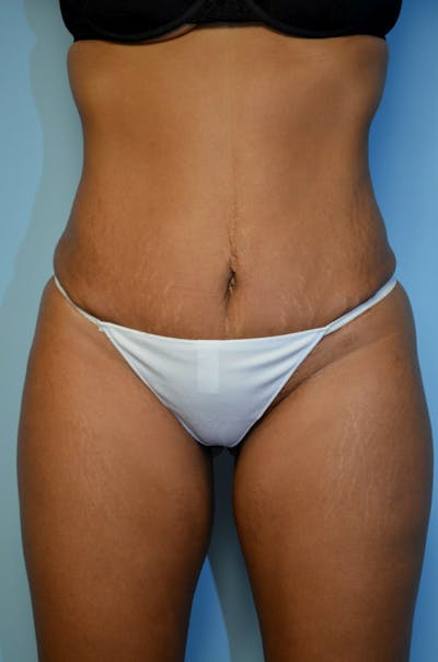 Liposuction Before & After Gallery - Patient 396232 - Image 2