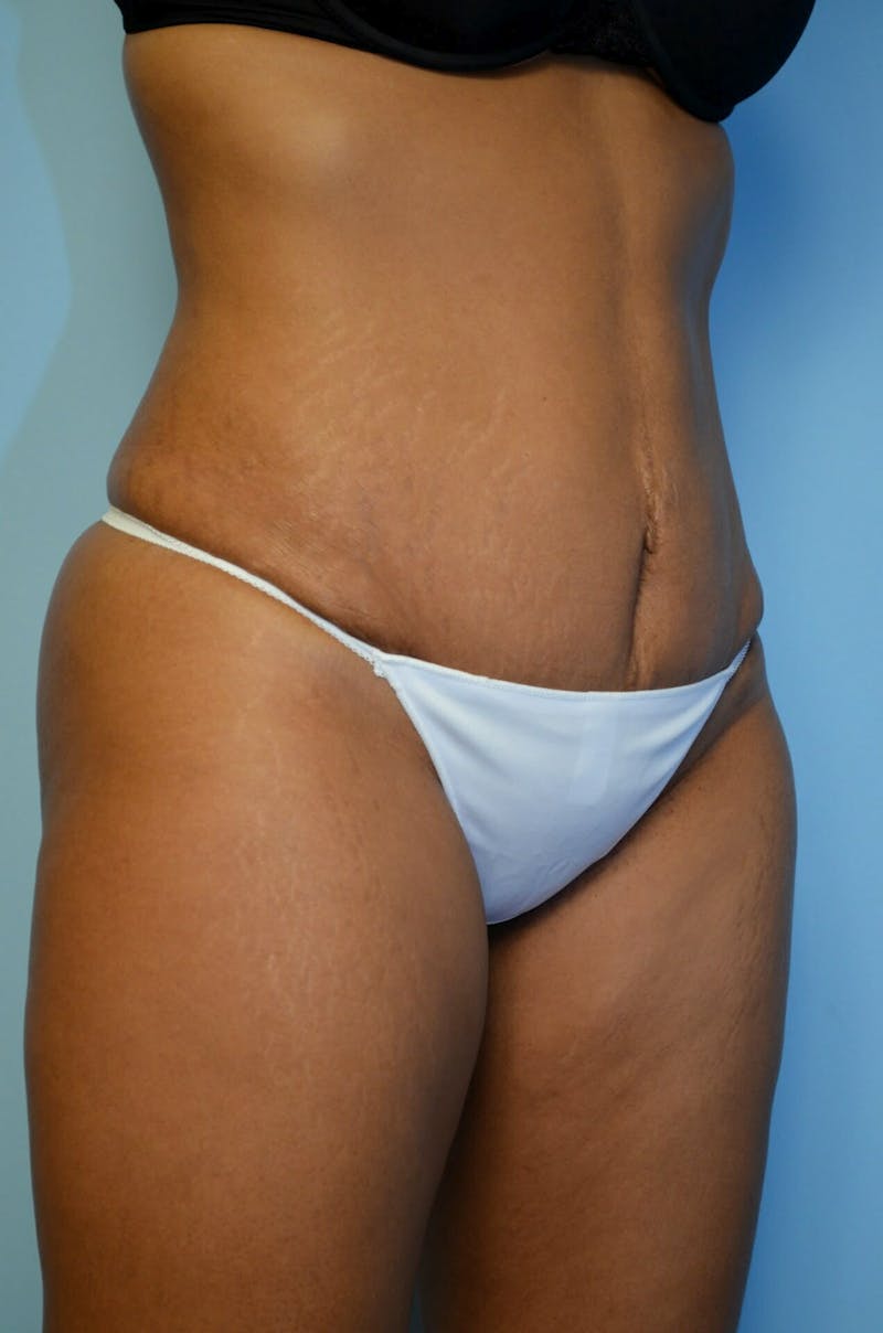 Umbilical Float Tummy Tuck Before & After Gallery - Patient 222524 - Image 4