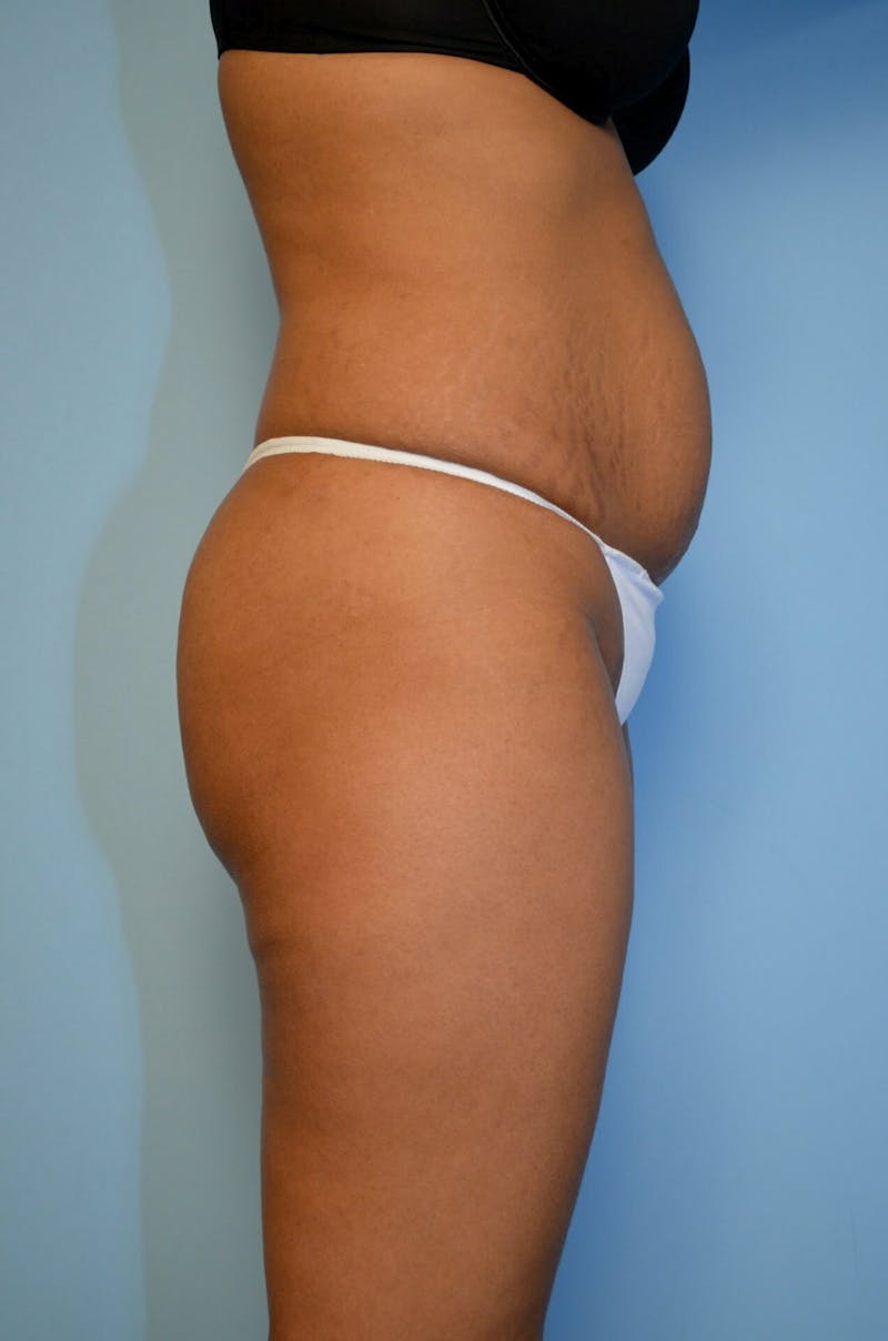 Umbilical Float Tummy Tuck Before & After Gallery - Patient 222524 - Image 5