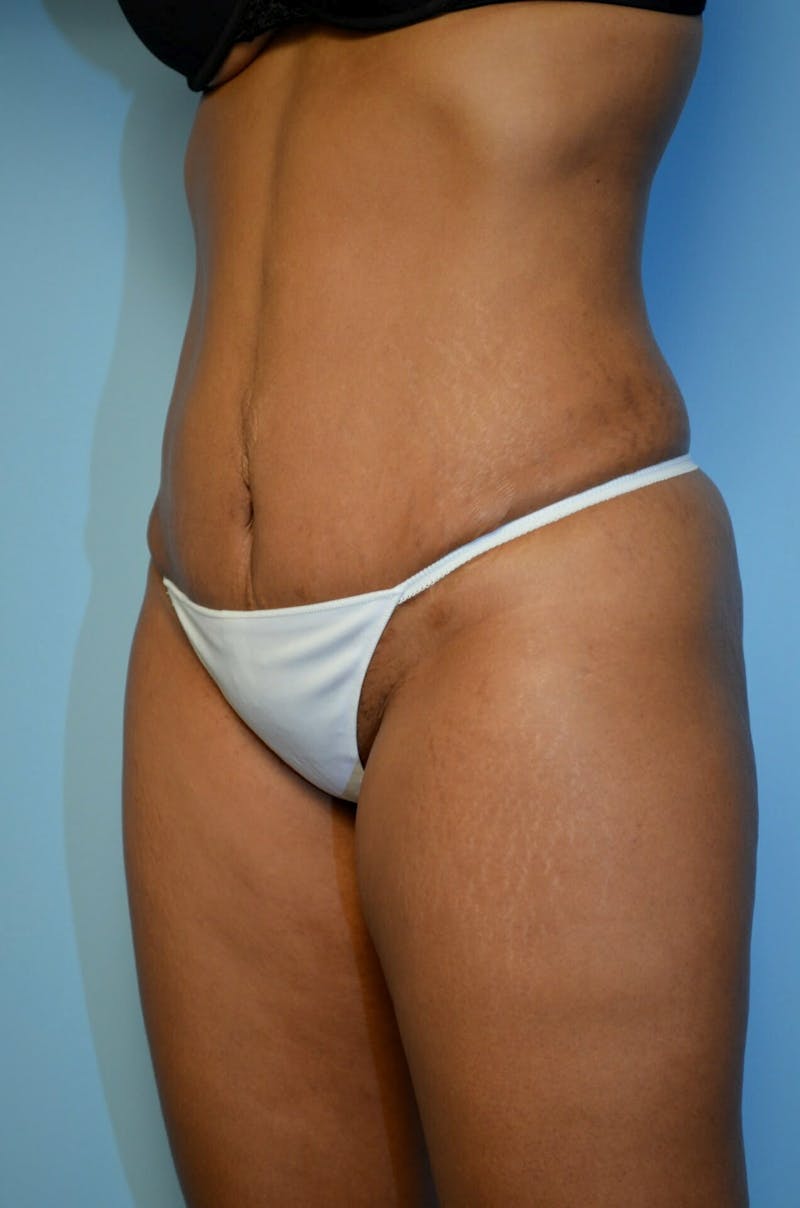 Umbilical Float Tummy Tuck Before & After Gallery - Patient 222524 - Image 8
