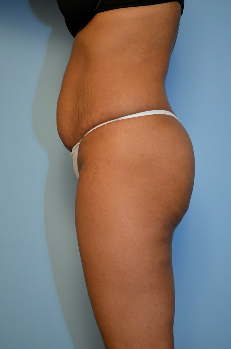 Umbilical Float Tummy Tuck Before & After Gallery - Patient 222524 - Image 9