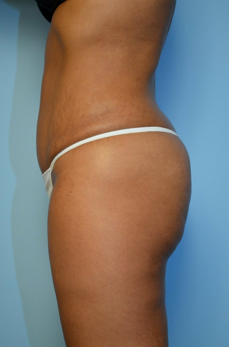 Umbilical Float Tummy Tuck Before & After Gallery - Patient 222524 - Image 10
