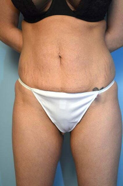 Umbilical Float Tummy Tuck Before & After Gallery - Patient 151251 - Image 1