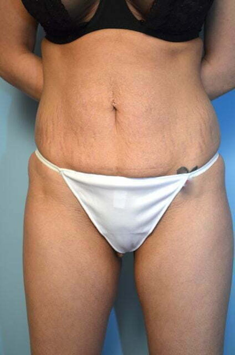 Umbilical Float Tummy Tuck Before & After Gallery - Patient 151251 - Image 1
