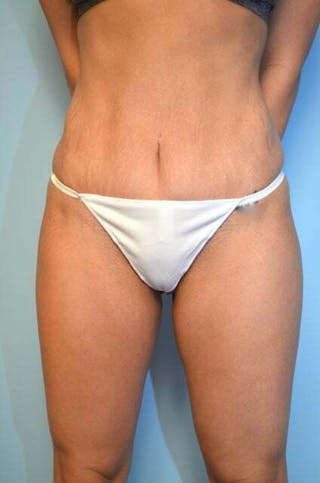 Umbilical Float Tummy Tuck Before & After Gallery - Patient 151251 - Image 2