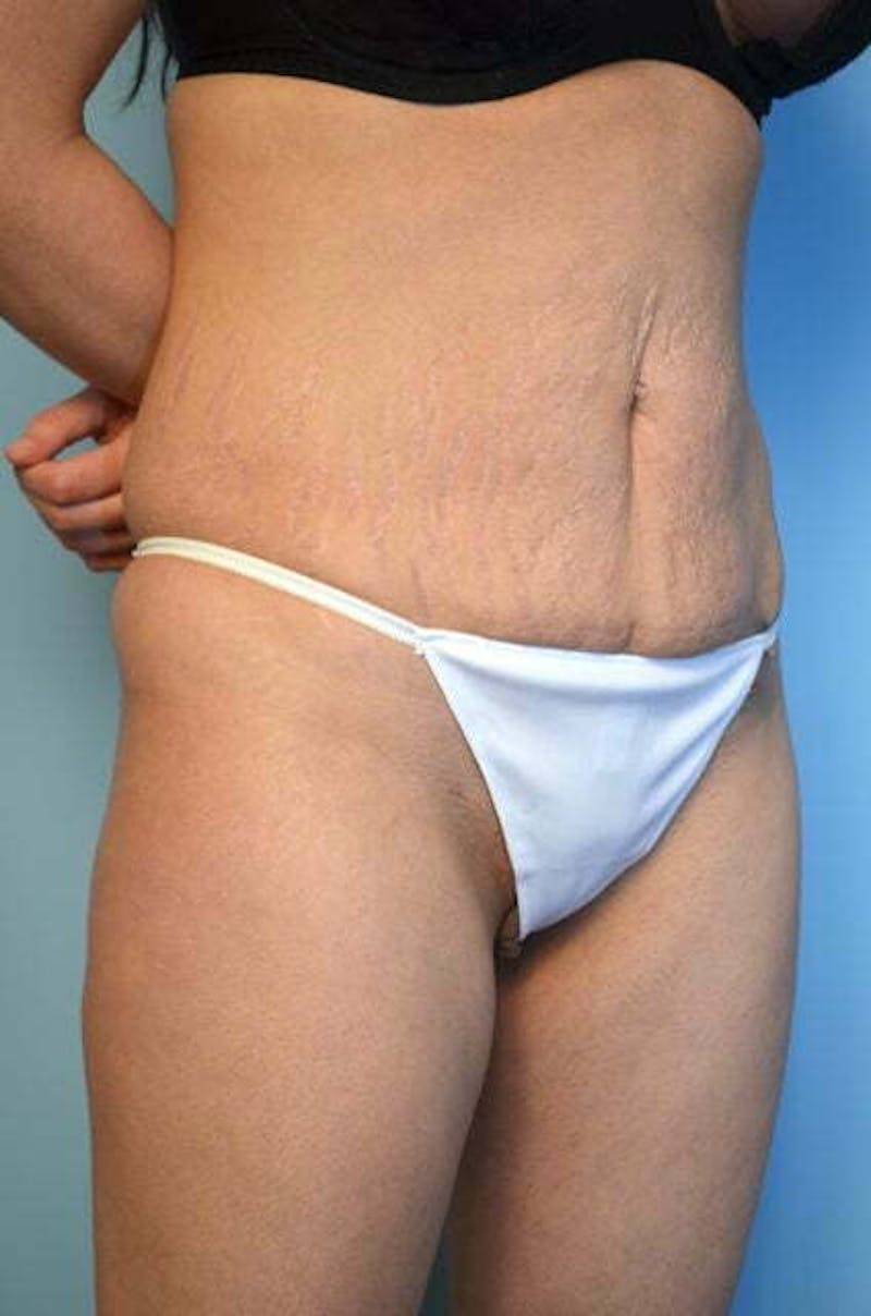 Umbilical Float Tummy Tuck Before & After Gallery - Patient 151251 - Image 3
