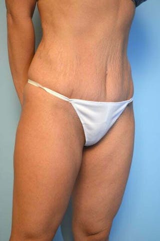 Umbilical Float Tummy Tuck Before & After Gallery - Patient 151251 - Image 4
