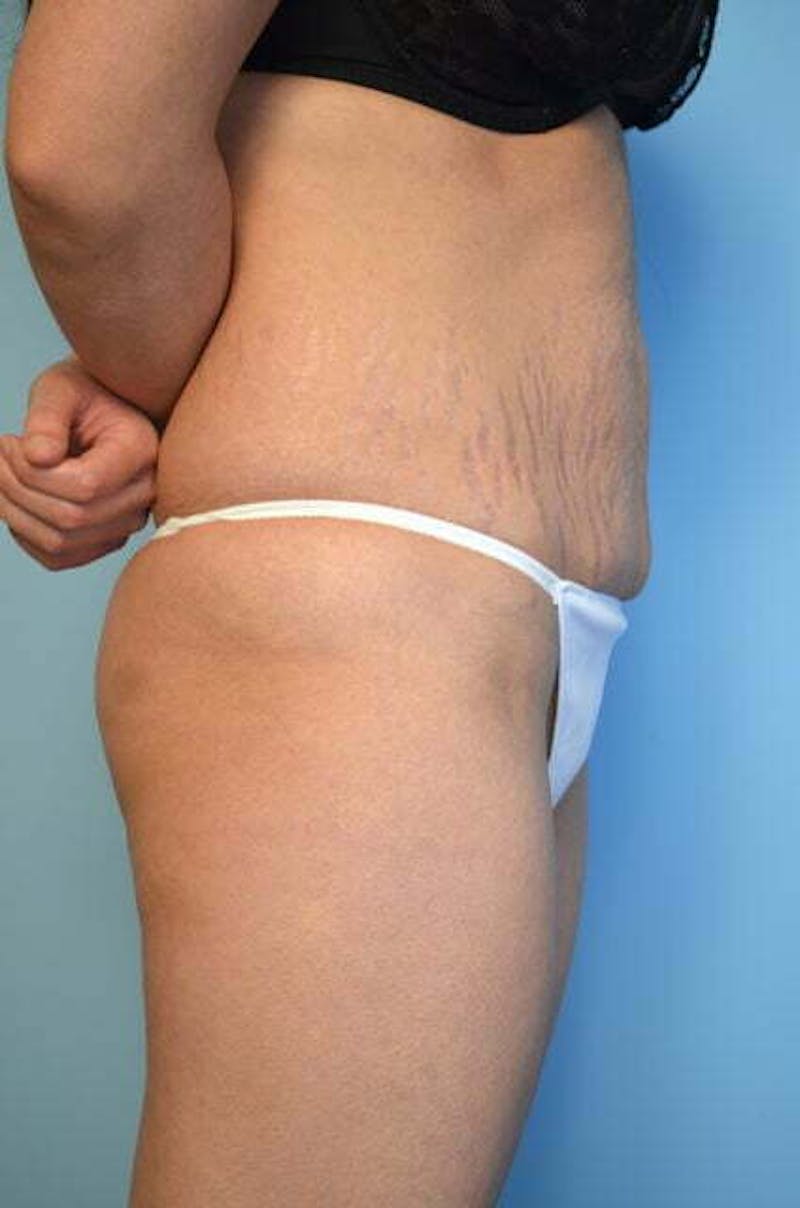 Umbilical Float Tummy Tuck Before & After Gallery - Patient 151251 - Image 5