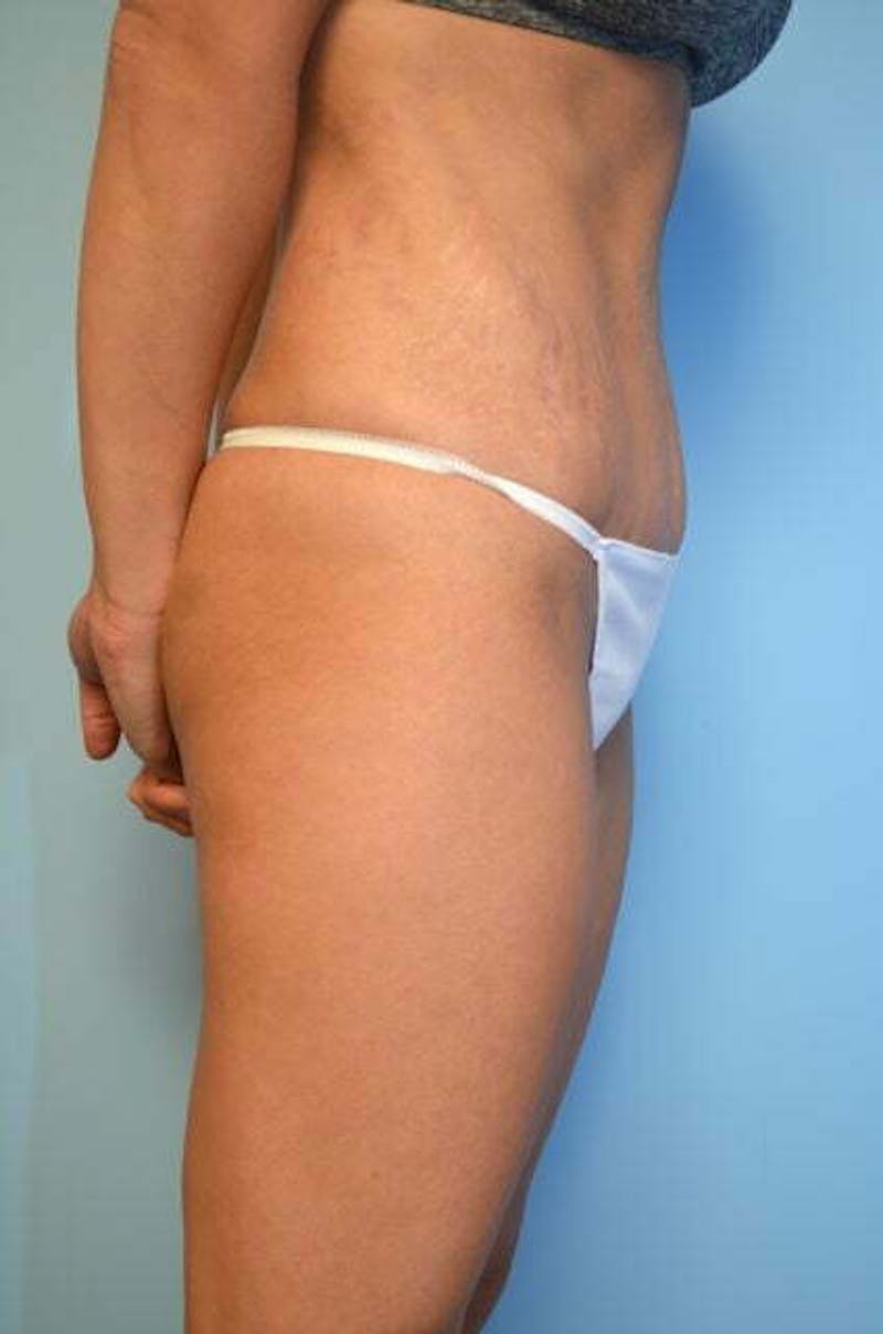Umbilical Float Tummy Tuck Before & After Gallery - Patient 151251 - Image 6