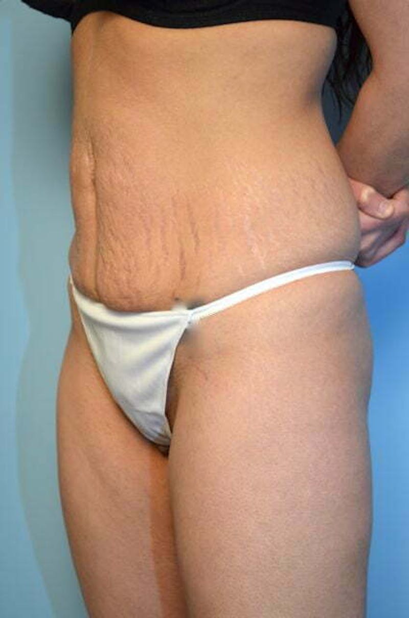 Umbilical Float Tummy Tuck Before & After Gallery - Patient 151251 - Image 7