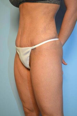 Umbilical Float Tummy Tuck Before & After Gallery - Patient 151251 - Image 8