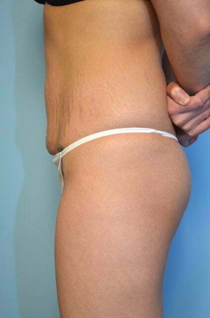 Umbilical Float Tummy Tuck Before & After Gallery - Patient 151251 - Image 9