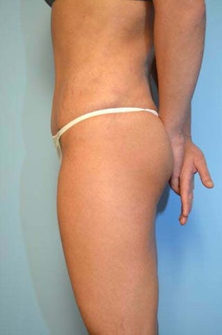 Umbilical Float Tummy Tuck Before & After Gallery - Patient 151251 - Image 10