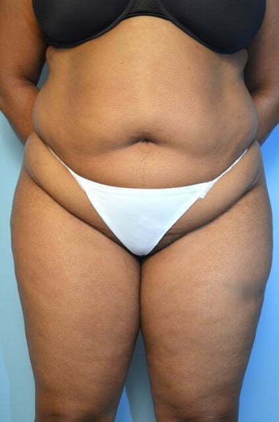 Liposuction Before & After Gallery - Patient 207609 - Image 1