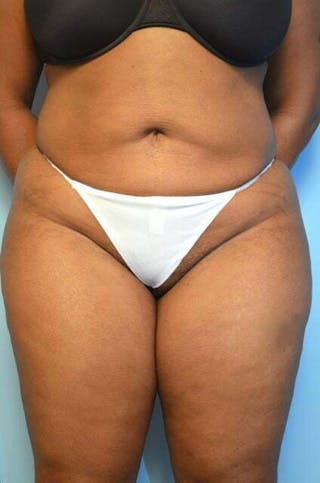 Liposuction Before & After Gallery - Patient 207609 - Image 2