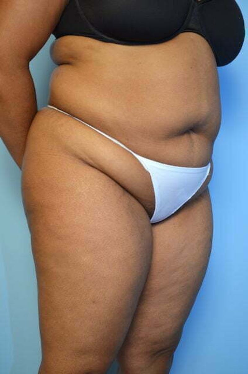 Liposuction Before & After Gallery - Patient 207609 - Image 3