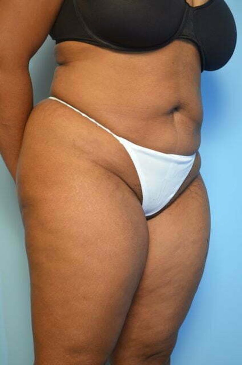 Liposuction Before & After Gallery - Patient 207609 - Image 4