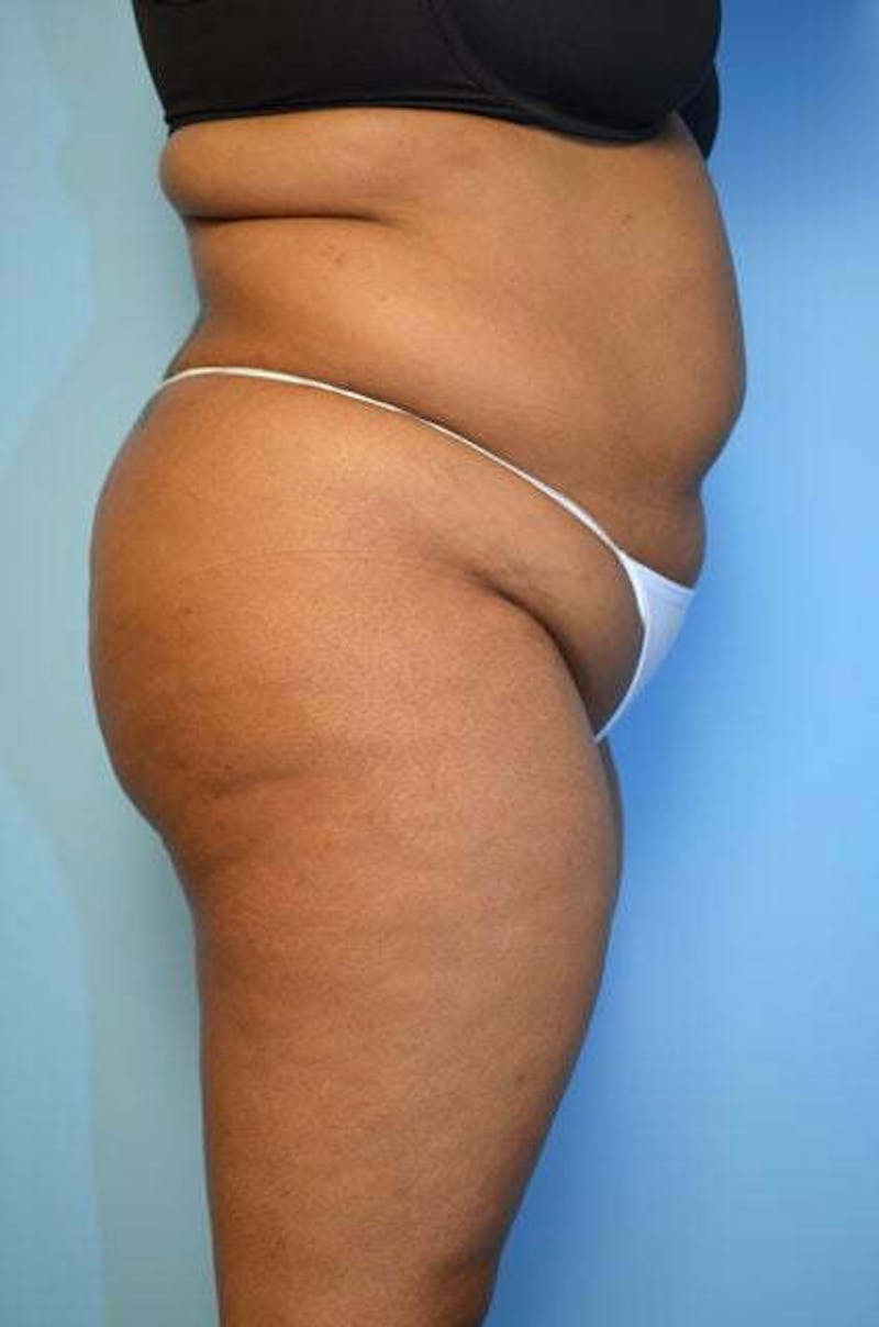 Liposuction Before & After Gallery - Patient 207609 - Image 5
