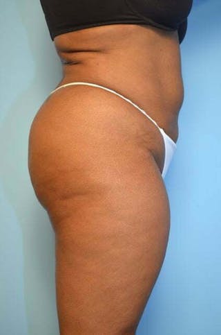 Liposuction Before & After Gallery - Patient 207609 - Image 6