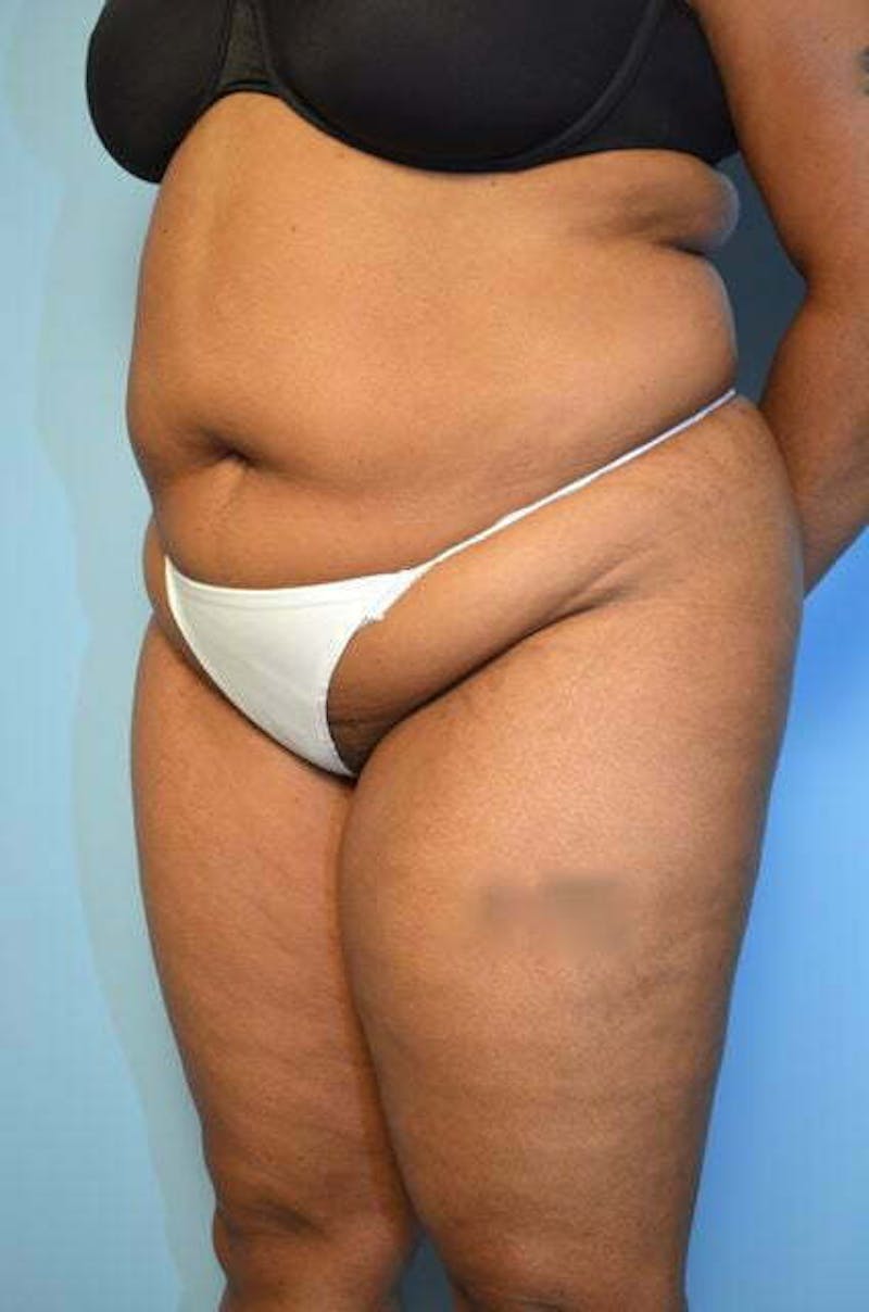 Liposuction Before & After Gallery - Patient 207609 - Image 7