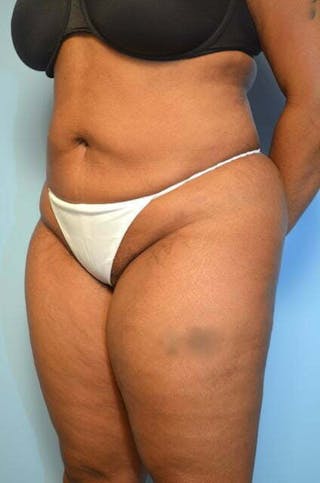 Liposuction Before & After Gallery - Patient 207609 - Image 8