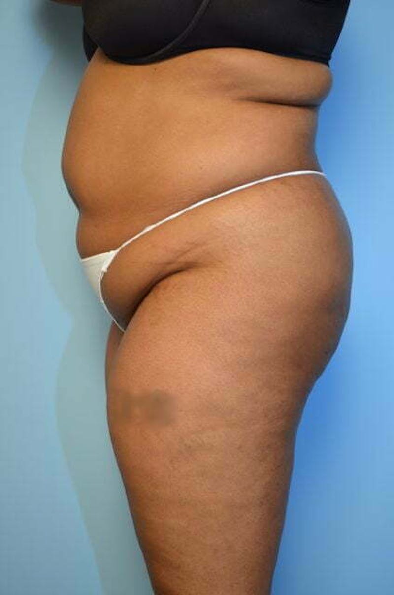 Liposuction Before & After Gallery - Patient 207609 - Image 9