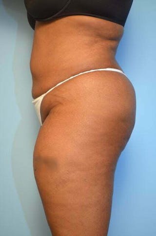 Liposuction Before & After Gallery - Patient 207609 - Image 10