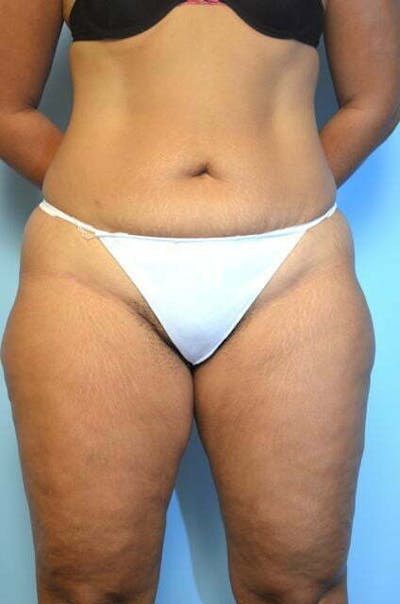 Liposuction Before & After Gallery - Patient 353481 - Image 1