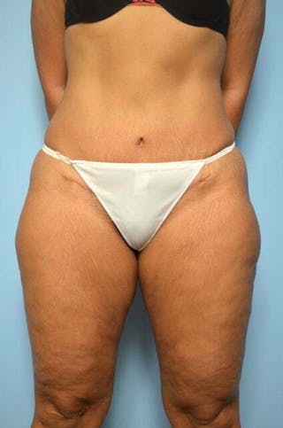 Umbilical Float Tummy Tuck Before & After Gallery - Patient 217291 - Image 2