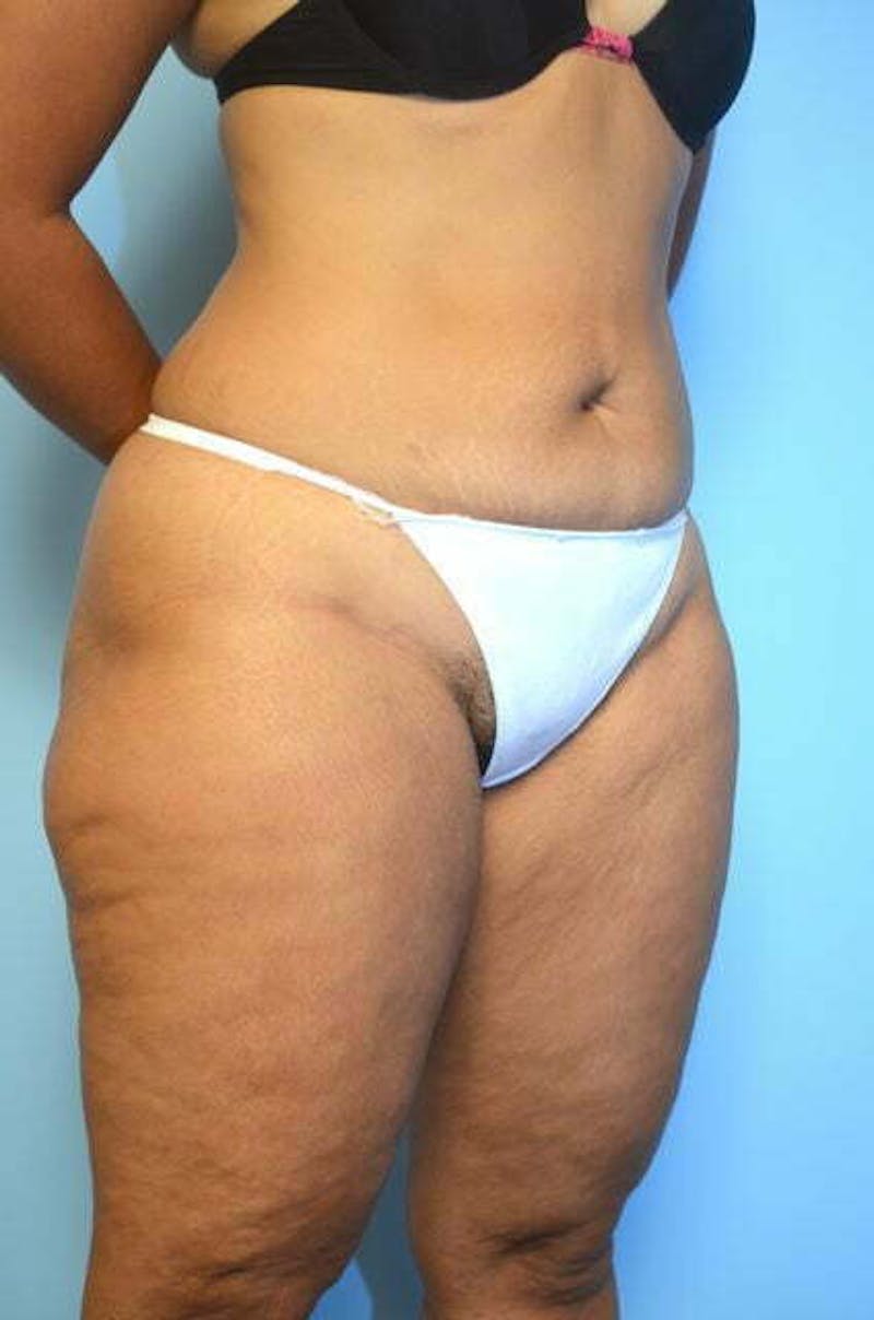 Umbilical Float Tummy Tuck Before & After Gallery - Patient 217291 - Image 3