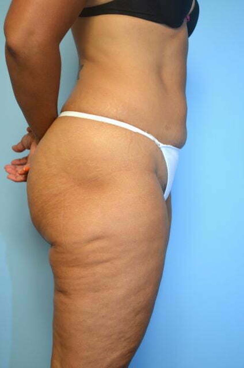 Umbilical Float Tummy Tuck Before & After Gallery - Patient 217291 - Image 5