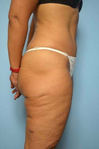 Umbilical Float Tummy Tuck Before & After Gallery - Patient 217291 - Image 6